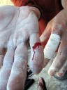 Kai Staats fingers bleed; photo by Ben Scott